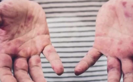 2025年宾州麻疹拉响警报,首例确诊于蒙哥马利县